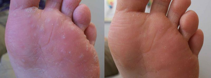 verrucosis%203.jpeg